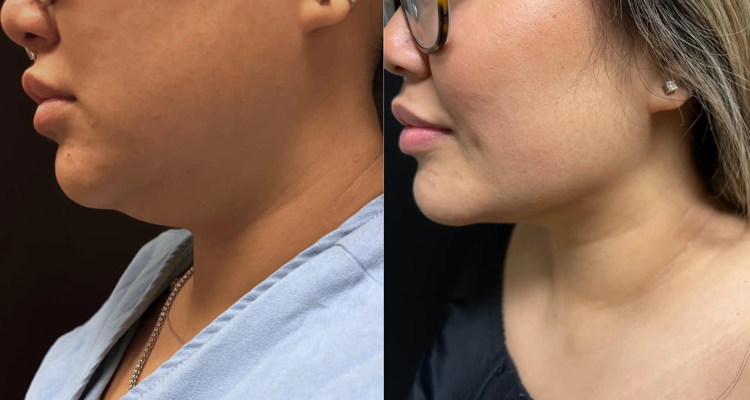 Image showing a side-by-side comparison of two individuals' profiles. The left profile features a person wearing a medical gown, highlighting their neck area. The right profile displays a person wearing glasses, showcasing their jawline and facial features. This image emphasizes contrasting facial structures and may relate to discussions on cosmetic procedures or facial anatomy.