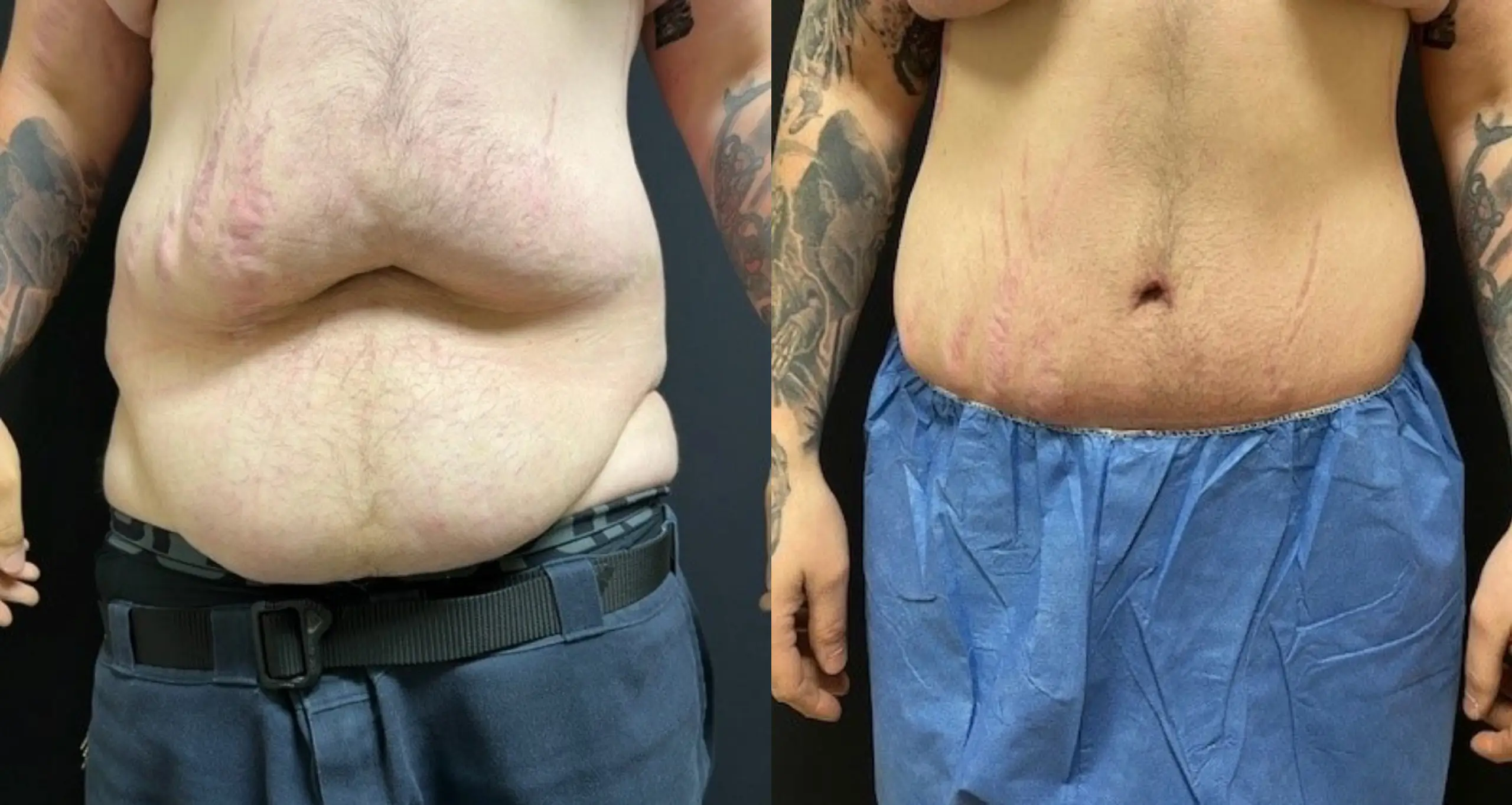 Before and after image showcasing a male torso with visible changes in abdominal appearance. The left side displays a protruding abdomen with loose skin, while the right side shows a more toned midsection, highlighting the effects of weight loss or body contouring. The individual is wearing blue medical shorts, and tattoos are visible on the right arm. This image is relevant for discussions on body transformation, weight management, and cosmetic procedures.