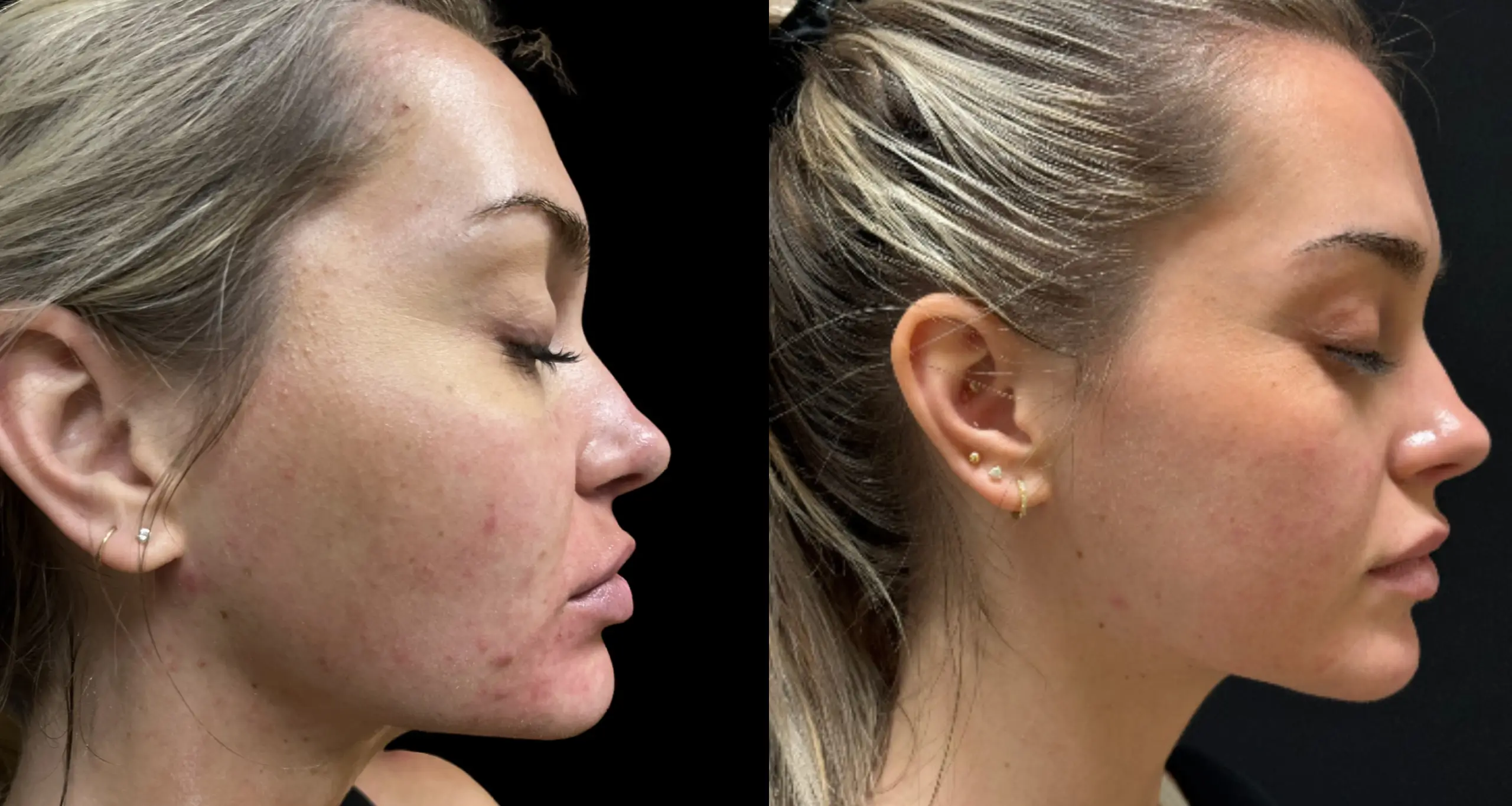 Before and after image showcasing a woman's profile, highlighting skin improvements. The left side displays a close-up of her face with visible acne and uneven skin texture, while the right side shows her improved skin condition with clearer complexion and reduced blemishes. This image illustrates the effectiveness of skincare treatments or dermatological procedures in enhancing skin health and appearance. Ideal for articles or blogs focused on skincare, acne solutions, or beauty transformations.